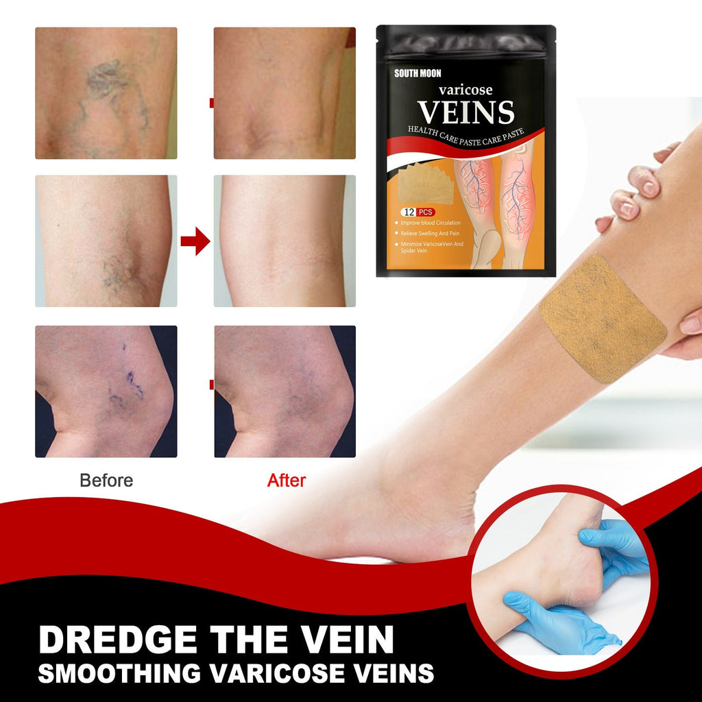 Venous health patch relieves varicose blood vessel blockage and protrusions in the feet. Cold compress venous health patch - Elevate